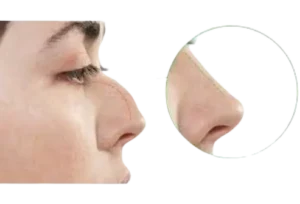 Rhinoplasty Surgery
