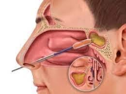 Sinus Treatment and FESS Surgery