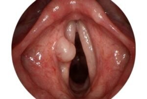 Vocal cord polyps surgery in Kukatpally